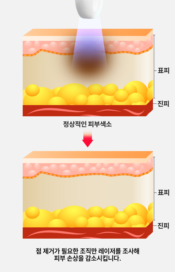 리윤피부과 잡티 제거