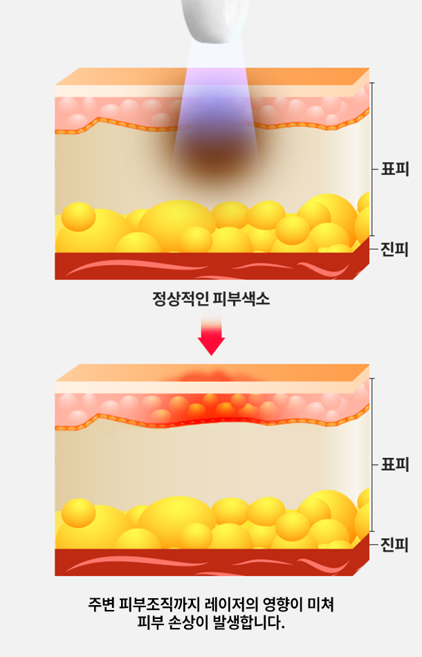 기존 방식의 잡티 제거
